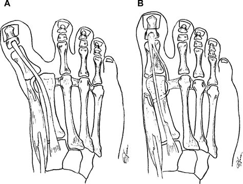 Tendon Transfers And Salvaging Options For Hallux Varus Deformities