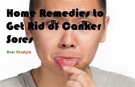 How To Naturally Get Rid Of Canker Sores In Minutes See More Details At