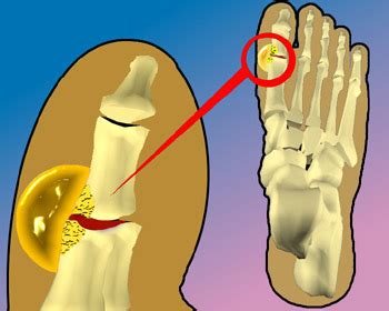 Gota y artritis gotosa en el pie Síntomas y tratamiento