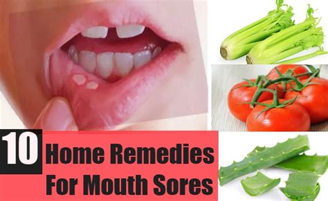Mouth Sores Home Remedies Treatments And Cures Lady Care Health