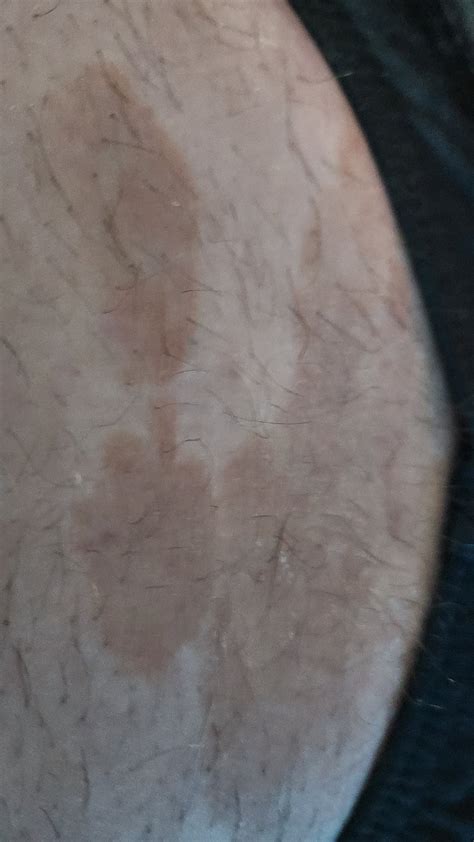 Discolored Skin Around Groin Rdermatologyquestions