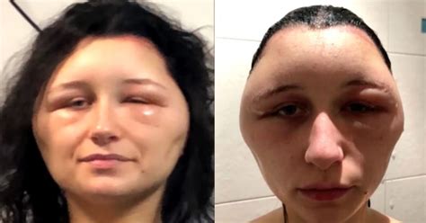 19 Year Old Left With A Swollen Head After An Extreme Allergic Reaction