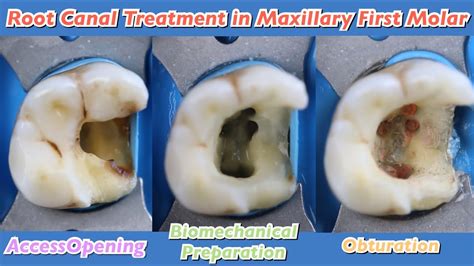 Root Canal Treatment In Maxillary First Molar Endostar E3 Azure