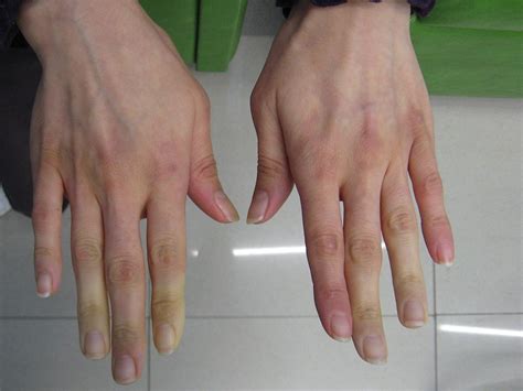 Cold Hands Raynauds Disease Autoimmune Diseases Articles Body