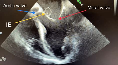 Cureus Aortic And Mitral Valve Infective Endocarditis Caused By