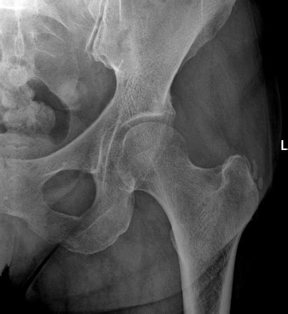 Gluteal Calcific Tendonitis Radiology Case Radiopaedia Org