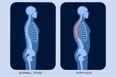 Have A Hunched Upper Back What To Know About Kyphosis The Healthy