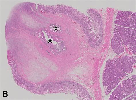 Lymphoplasmacytic Granuloma Localized To The Ampulla Of Vater An Ampullary Lesion Of IgG
