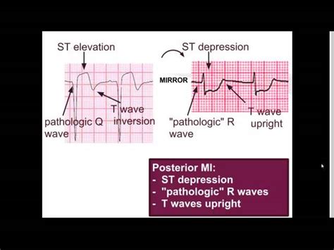 Posterior Wall Mi Is Best Identified In Which Leads