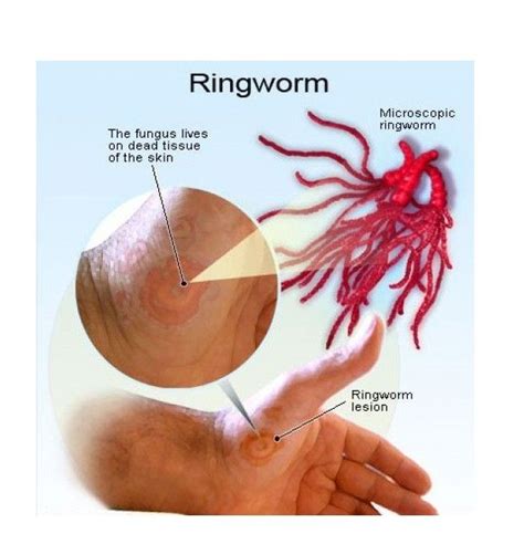 Beware Of Ringworm Home Remedies For Ringworm Ringworm Remedies Get