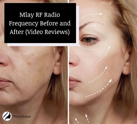 Mlay Rf Radio Frequency Before And After Treatment Videos