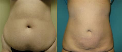 Abdomen Liposuction Cincinnati Transform Medspa