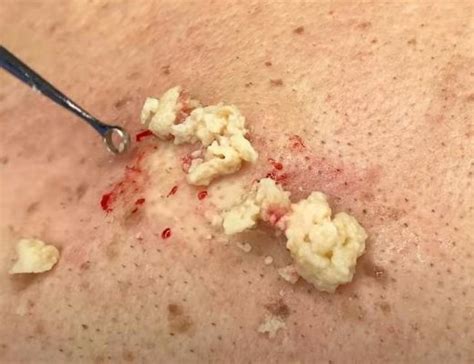 Can I Stick A Needle In A Sebaceous Cyst New Pimple Popping Videos