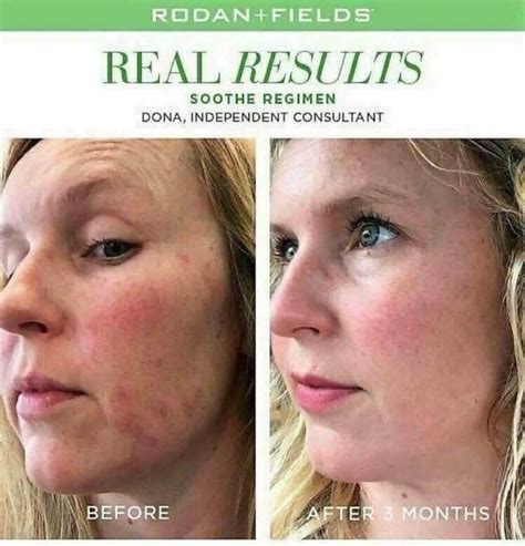 Soothe Regimen For Sensitive Dry Red Skin Rodan And Fields Soothe