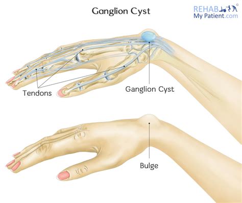Ganglion Cyst Wrist Pictures Volar Retinacular Cysts They Grow Out Of The Tissues Surrounding