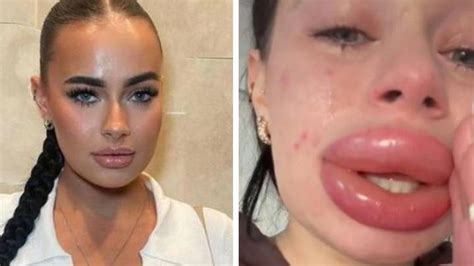 Influencer Warns Followers Not To Accept Free Fillers After Her Lips Swell Up