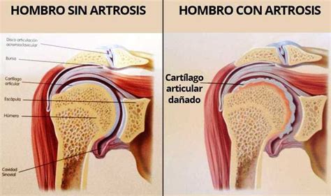 Articulación Del Hombro Anatomía Función Dolor Lesiones Y Más