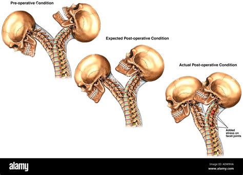 Extension Of Vertebral Column Hi Res Stock Photography And Images Alamy