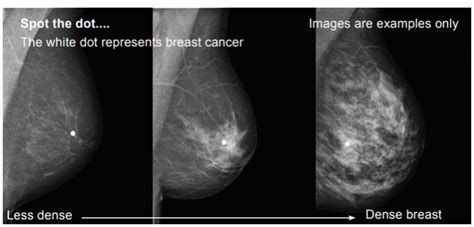 In a mammogram, the dense tissue of breast lumps may show up in the picture. What are dense breasts? » My BreastScreen