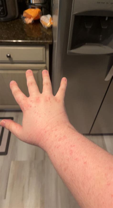 I 19 Amab Have This Rash On My Arms Wondering If Its Cause For