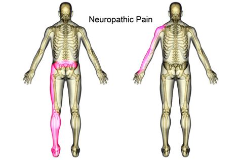 Neuropathic Pain Symptoms And Treatment