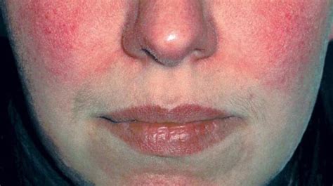 The Stages Of Rosacea