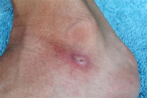 What Causes Red Spots On Feet Other Symptoms And Treatment 2022