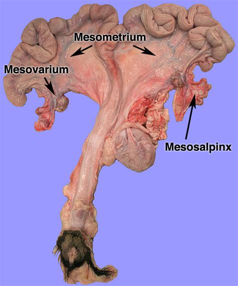 Broad ligament (fold of peritoneum extending from lateral border of uterus to the lateral pelvic wall). Broad Ligament Labeled