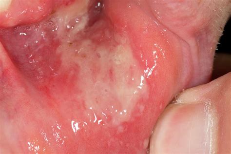 Extensive Mouth Ulcer Photograph By Dr P Marazziscience Photo Library