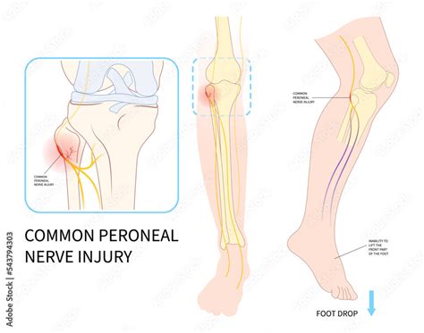 Plakat Feet Drop Palsy Leg Injury And Ankle Pain Trauma Spine Lower
