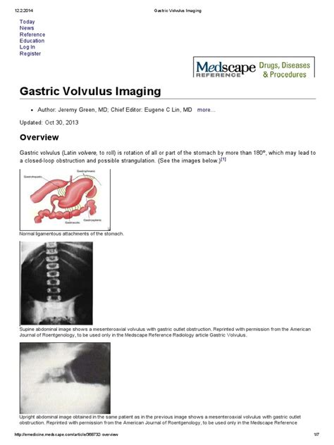 Gastric Volvulus Imaging Radiology Medical Imaging