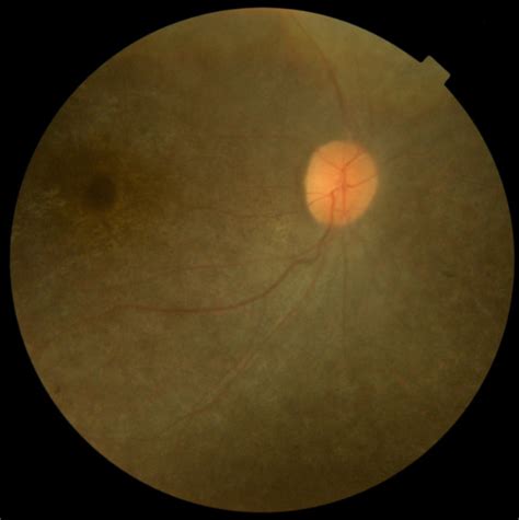 Fundus Photograph Of Patient 2 The Fundus Showed Salt And Pepper