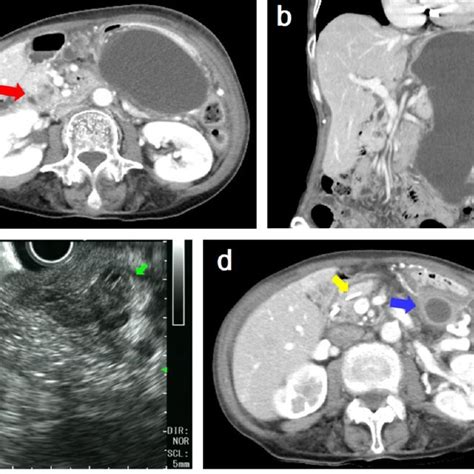 Imaging Diagnosis Of The Pancreas Tumor A Abdominal Computed