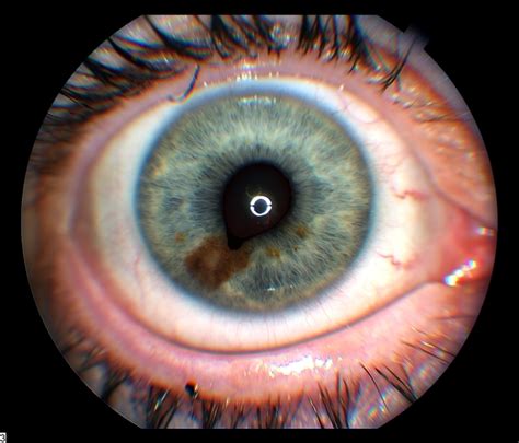 The longer you focus on the small black dot but why do cone cells in your eyes become fatigued to begin with? Iris Nevus - Retina Image Bank
