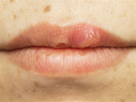 Hiv Mouth Sores Pictures Causes Treatment And Prevention