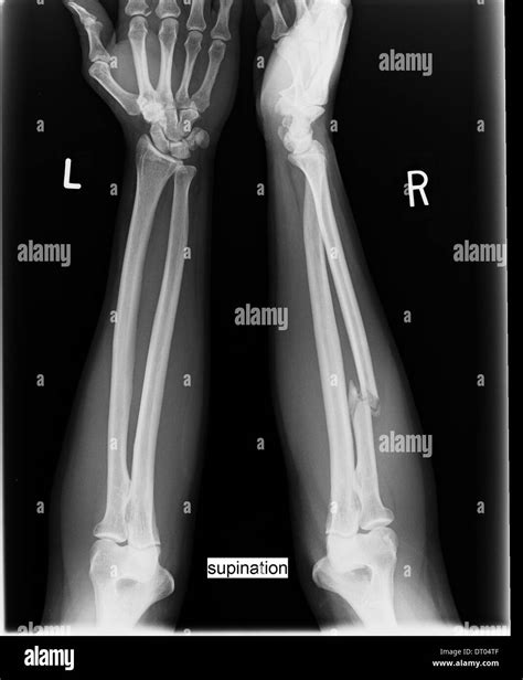 Comparative X Ray Of Human Forearms Displays Fracture Of The Right
