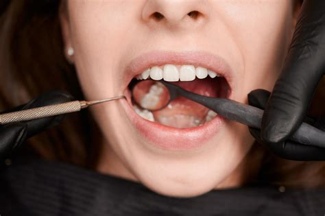 Cuanto Cuesta Sacar Una Muela Del Juicio Somos Dental