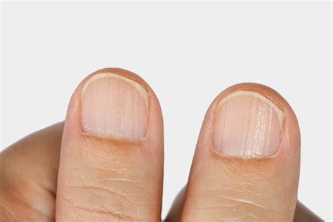Ridges In Fingernails Types Causes And Treatment