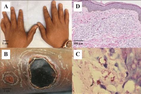 A Oedema Of The Hands B Leg Ulcers C Microscopic Examination Of A
