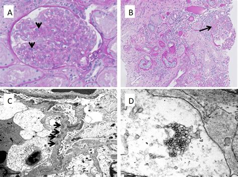Other signs may include a skin rash, fever, weight loss, or drenching night sweats. Angioimmunoblastic T-cell Lymphoma: A Mimic for Lupus