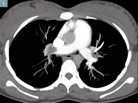 Pulmonary Embolism Diagnosis in Pregnancy How Bicêtre Hospital Overcomes Imaging Challenges