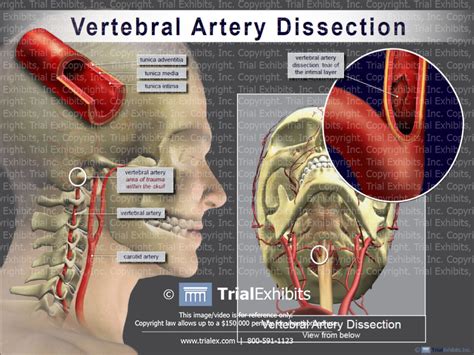 Vertebral Artery Dissection Trial Exhibits Inc