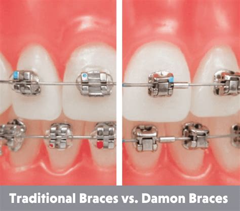 Damon Braces Self Ligating Brace Park Orthodontics Glasgow
