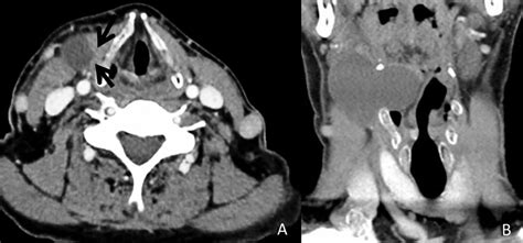 Thyroglossal Duct Cyst Masquerading As A Laryngocele Bmj Case Reports