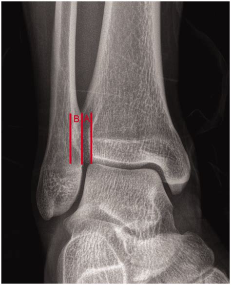X Ray Measurement Of The Distal Tibiofibular Syndesmosis The Space