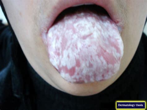 Oral Candidiasis Thrush Dermatology Oasis