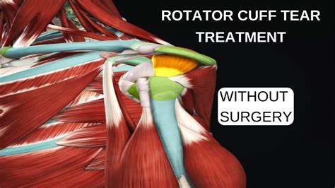 rotator cuff tear surgery