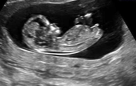 Early Pregnancy Scan 8 14 Weeks Ultrasound Women Scans
