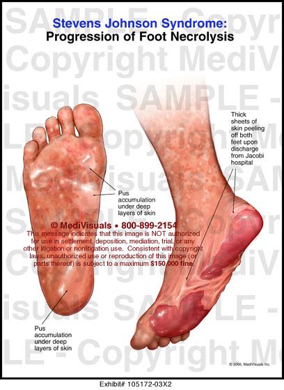 Stevens Johnson Syndrome Progression Of Foot Necrolysis Medical Exhibit