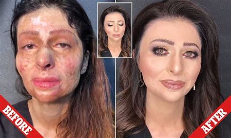 acid attack victims before and after kasey well costa